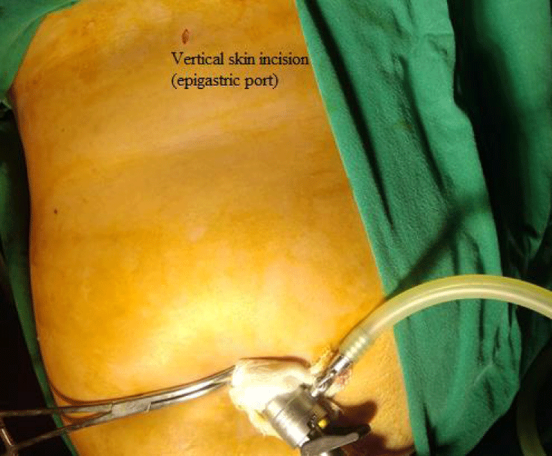 Single-Port Cholecystectomy Technique: Laparoscopic Cholecystectomy via  Single Port, Complications